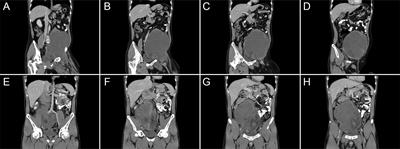 Abdominoinguinal approach in en bloc resection of retroperitoneal sarcoma involving iliac vessels with graft interposition